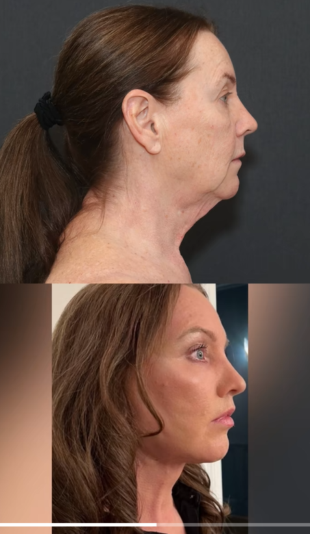 Seite-an-Seite-Profilansichten der Ergebnisse von Tina Heatons Deep Plane Facelifting und Halslifting, die Dr. Mike Nayak als Reaktion auf die Ungläubigkeit im Internet geteilt hat. | Quelle: TikTok/nayakplasticsurgery