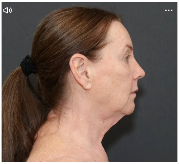 Seitenprofil von Tina Heaton vor der Operation, wobei die schlaffe Haut am Hals und am Kiefer sichtbar ist. | Quelle: TikTok/nayakplasticsurgery