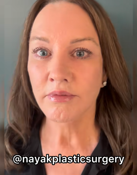 Frontalaufnahme von Tina Heaton nach der Operation, die von Dr. Mike Nayak veröffentlicht wurde, um die Rechtmäßigkeit der Ergebnisse ihrer Gesichtsverjüngung zu bestätigen. | Quelle: TikTok/nayakplasticsurgery