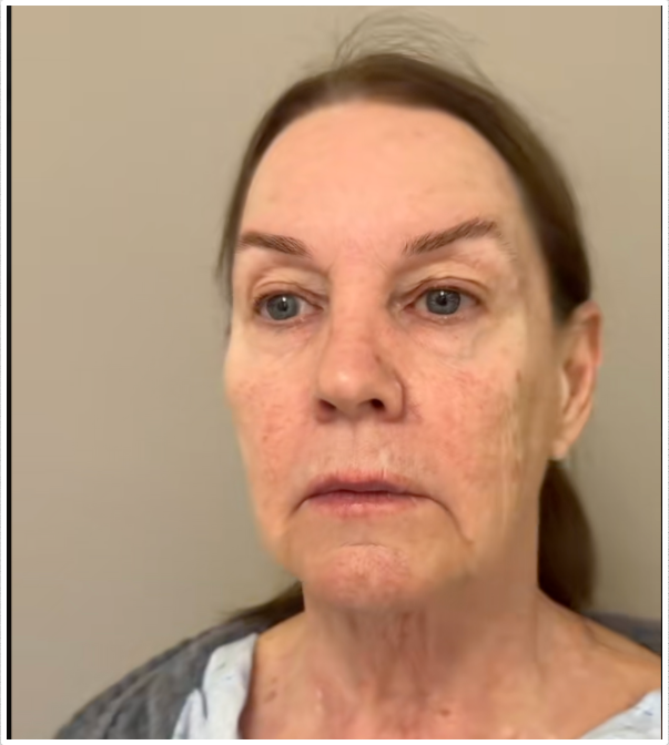 Tina Heaton, vor der Operation, mit sichtbarem Volumenverlust im Gesicht und ersten Anzeichen des Alterns. | Quelle: TikTok/nayakplasticsurgery
