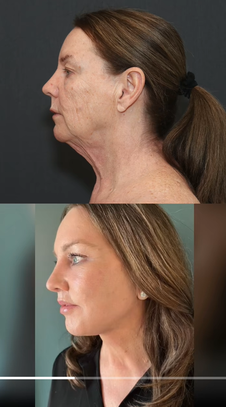 Vorher-Nachher-Vergleich des Profils von Tina Heaton, den Dr. Mike Nayak veröffentlicht hat, um der öffentlichen Skepsis über die Echtheit ihrer Verwandlung zu begegnen. | Quelle: TikTok/nayakplasticsurgery